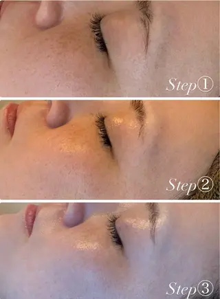 ニキビ・毛穴改善 🌿ハーブピーリングのエステ・リラクイメージ