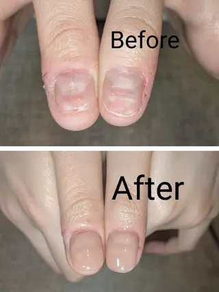 ネイル ネイリストゆか💅 長さだし、深爪矯正のネイルデザイン