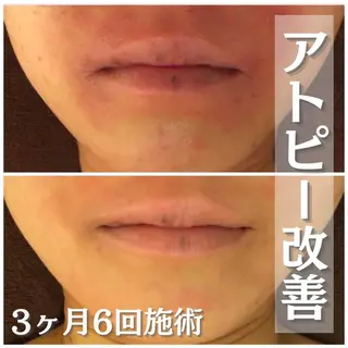 セミロング カラー パーマ ヘアアレンジ メンズ キッズ ネイル マツエク・マツパ アイブロウ 🔥3か月で肌革命 🔥ニキビ専門店のエステ・リラクイメージ