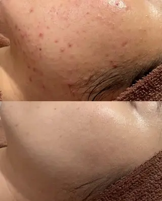 ニキビ・肌質改善専門 ♡人生が変わるサロンのエステ・リラクイメージ