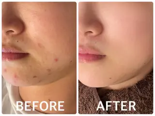 ハーブピーリング 🌿京橋のエステ・リラクイメージ