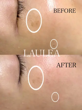 シミケア/ハーブピーリング/脱毛/小顔フェイシャル/ハーブ温浴 LAULEA所属・素肌をキレイに ラウレア🌼Hayaのエステ・リラクイメージ