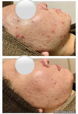 セミロング カラー パーマ ヘアアレンジ メンズ キッズ ネイル マツエク・マツパ アイブロウ 肌質体質を変えて すっぴん肌にのエステ・リラクイメージ