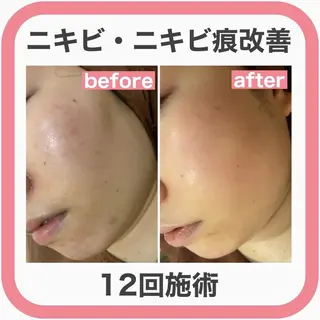 セミロング カラー パーマ ヘアアレンジ メンズ キッズ ネイル マツエク・マツパ アイブロウ 🔥3か月で肌革命 🔥ニキビ専門店のエステ・リラクイメージ