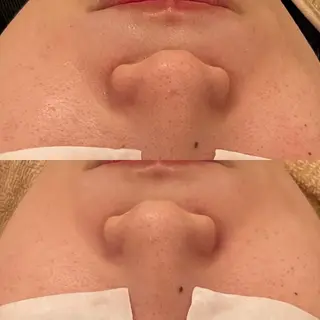 毛穴ケア/毛穴診断/ 毛穴洗浄〔心斎橋〕のエステ・リラクイメージ