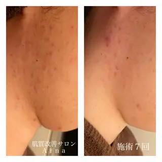 ロング カラー パーマ ヘアアレンジ メンズ キッズ ネイル マツエク・マツパ ニキビ跡専門サロン Ａｉｎａのエステ・リラクイメージ