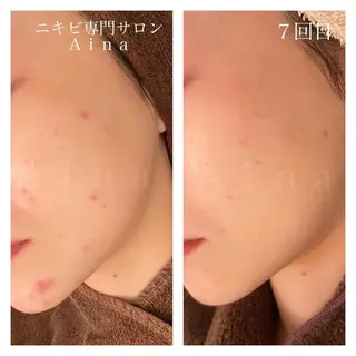 ミディアム パーマ ヘアアレンジ メンズ キッズ ネイル マツエク・マツパ ニキビ跡専門サロン Ａｉｎａのエステ・リラクイメージ