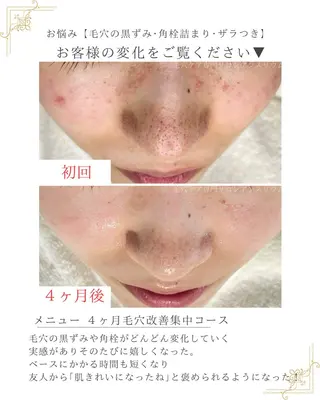 毛穴ケア専門サロンアンスリウム所属・茨城土浦 つくば毛穴 ケア専門サロンのエステ・リラクイメージ