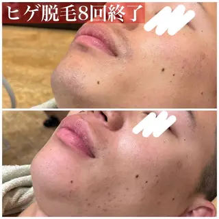 HAIRS YOSHIOKA所属・ヘアーズヨシオカ MENSヒゲ脱毛のエステ・リラクイメージ