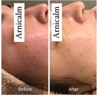 ハーブピーリング 肌再生ピーリング/のエステ・リラクイメージ