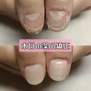 ネイル 深爪矯正/爪育成ケア manie nailのネイルデザイン