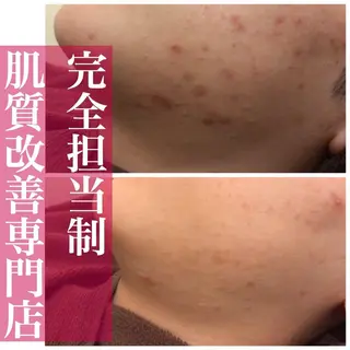 🔥3か月で肌革命 🔥ニキビ専門店のエステ・リラクイメージ