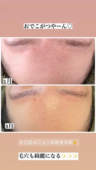 ニキビ・毛穴改善 🌿ハーブピーリングのエステ・リラクイメージ