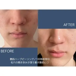 himee所属・艶肌ハーブピーリング /毛穴洗浄のエステ・リラクイメージ