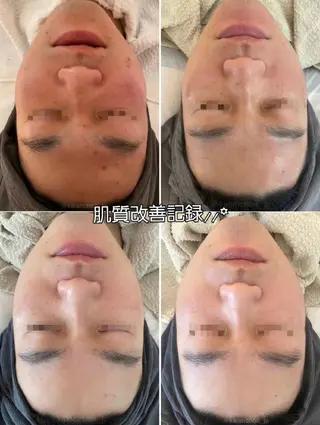 肌質改善 KALANCHOEのエステ・リラクイメージ