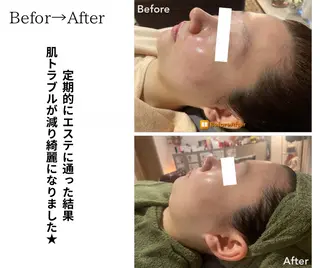 Meupニキビ専門店 背中/ハーブ/肌管理のその他イメージ