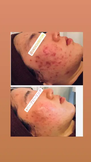 ニキビ/肌質改善専門 Snow skinのエステ・リラクイメージ