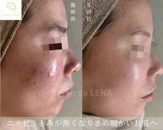 ハーブピーリング・毛穴ケア専門サロンSalon de LENA 栄店所属・ハーブピーリング専門 サロンドレナ　白藤のエステ・リラクイメージ