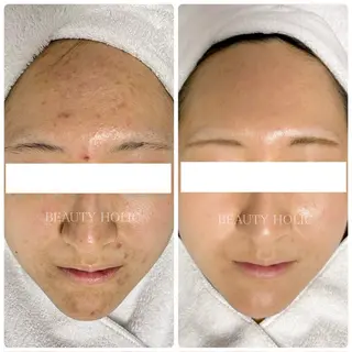 ニキビ・ 肌荒れ専門店のエステ・リラクイメージ