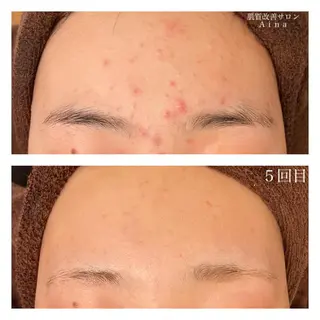 セミロング カラー パーマ ヘアアレンジ メンズ キッズ ネイル マツエク・マツパ ニキビ跡専門サロン Ainaのエステ・リラクイメージ