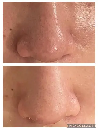 🔥3か月で肌革命 🔥ニキビ専門店のエステ・リラクイメージ