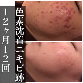 夏までに肌荒れ卒業 するサロン🌻のエステ・リラクイメージ