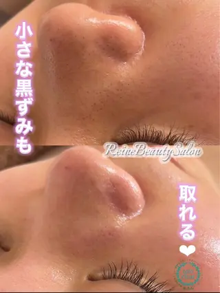 Reine BeautySalon所属・毛穴/シミ肝斑/脱毛 横山梨里のエステ・リラクイメージ