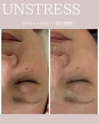 【毛穴•ハーブピーリング】 ニキビ対策サロンétoile クリスティーナ正規取扱店所属・松尾 佳奈のエステ・リラクイメージ