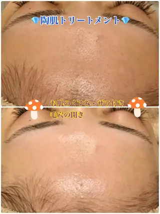 【リベルハーブピーリング認定店】敏感肌・美白脱毛専門店Dione立川店所属・Dione 立川店のエステ・リラクイメージ