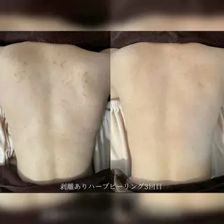 美肌ケアサロンhalu【ハーブピーリング/脱毛】所属・美肌ケアサロン halu（ハル）のその他イメージ