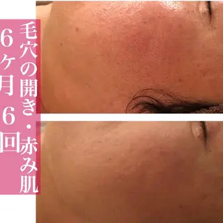 ニキビ特化型エステ 🍓最短で肌質改善のエステ・リラクイメージ