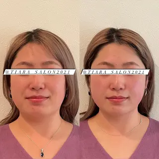 美容鍼灸サロン　TIARA所属・鍼灸サロン TIARA　美容鍼のエステ・リラクイメージ