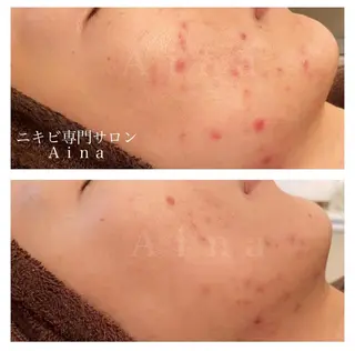 セミロング パーマ ヘアアレンジ メンズ キッズ ネイル マツエク・マツパ アイブロウ ニキビ跡専門サロン Ａｉｎａのエステ・リラクイメージ