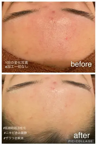 ニキビ跡改善専門🔥 医療にはできない改善のエステ・リラクイメージ