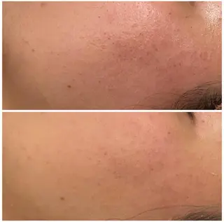 ニキビ跡改善専門🔥 医療にはできない改善のエステ・リラクイメージ