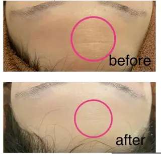 都内で出来る肌管理！ 最短ニキビ改善のエステ・リラクイメージ