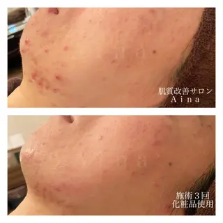 ミディアム カラー パーマ ヘアアレンジ メンズ キッズ ネイル マツエク・マツパ ニキビ跡専門サロン Ainaのエステ・リラクイメージ