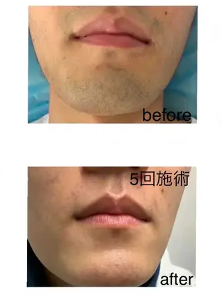 メンズ メンズ美肌脱毛 seekest.のエステ・リラクイメージ