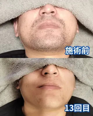 メンズ メンズ脱毛専門店Oceans所属・メンズ眉毛・脱毛専門 Oceansの眉毛・アイブロウイメージ