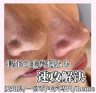 Reine BeautySalon所属・毛穴/シミ肝斑/脱毛 横山梨里のエステ・リラクイメージ