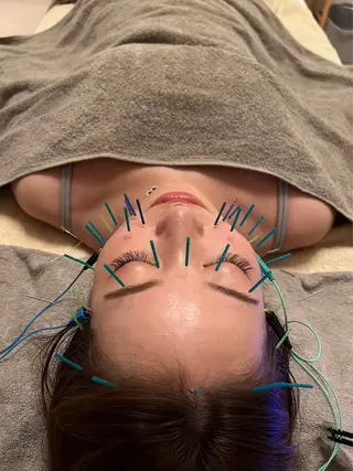 鍼灸•マッサージサロンCalfa所属・《美肌･小顔》美容鍼 ＆マッサージ＊MEIのエステ・リラクイメージ