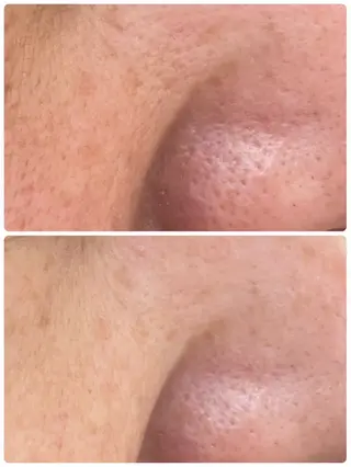 NARIS BEAUTY STATION　デ・アイム あべのルシアス所属・ニキビ跡/毛穴/ 肌質改善/北村ももこのエステ・リラクイメージ