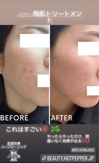 ハーブピーリング/韓国肌管理/フェイシャル/毛穴洗浄/眉毛/顔脱毛【糸脱毛専門】rev所属・ハーブピーリング🌹 毛穴洗浄❤️眉waxのエステ・リラクイメージ