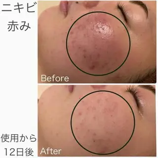 学生ニキビ改善🍀 優しい肌質改善のエステ・リラクイメージ