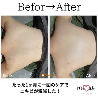 Meupニキビ専門店 背中/ハーブ/肌管理のその他イメージ