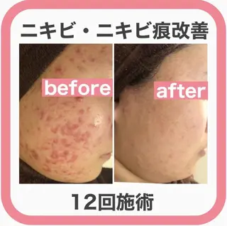 夏までに肌荒れ卒業 するサロン🌻のエステ・リラクイメージ