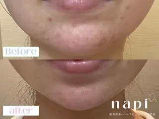 ハーブピーリング 専門店napiのエステ・リラクイメージ