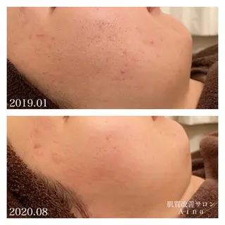 ミディアム カラー パーマ ヘアアレンジ メンズ キッズ ネイル マツエク・マツパ ニキビ跡専門サロン Ainaのエステ・リラクイメージ