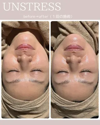 【毛穴•ハーブピーリング】 ニキビ対策サロンétoile クリスティーナ正規取扱店所属・松尾 佳奈のエステ・リラクイメージ