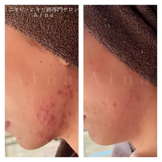 ニキビ跡専門サロン Ａｉｎａのエステ・リラクイメージ